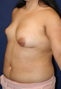 22 year old woman treated with Breast Reconstruction for Asymmetry