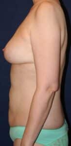44 Year-Old-Female Underwent Bilateral Breast Reduction and Abdominal Liposuction
