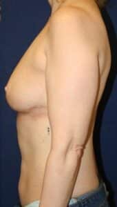 55 Year-Old-Woman Who Underwent Oncoplastic Breast Reduction