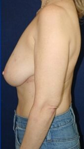 55 Year-Old-Woman Who Underwent Oncoplastic Breast Reduction