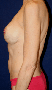 51 Year-Old-Female Underwent Bilateral Implant Based Breast Reconstruction After Mastectomy