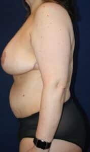 47-year-old female who underwent Bilateral Breast Reduction and Abdominoplasty