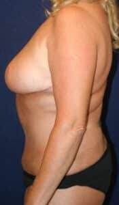 57-year-old female who underwent Bilateral Breast Reduction and Abdominoplasty with additional liposuction