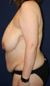 47-year-old female who underwent Bilateral Breast Reduction and Abdominoplasty