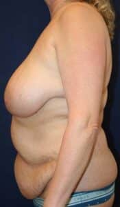 57-year-old female who underwent Bilateral Breast Reduction and Abdominoplasty with additional liposuction