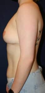 19-year-old female who underwent left breast reduction and right mastopexy