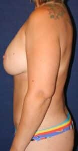 42-year-old female who underwent Bilateral Breast Augmentation, Mastopexy, and Abdominoplasty