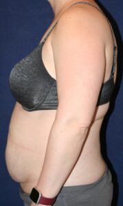 41-year-old female who underwent Abdominoplasty and lateral torso Liposuction