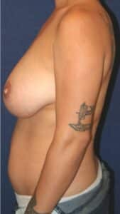 36-year-old female who underwent bilateral breast reduction