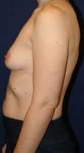 45-year-old female who underwent bilateral implant-based reconstruction after mastectomy