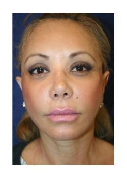 Facelift and Upper Blepharoplasty