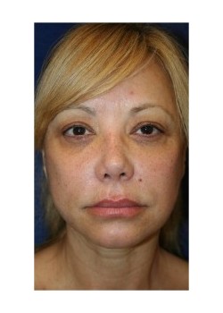 Facelift and Upper Blepharoplasty