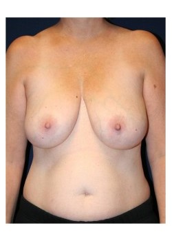 Implant (round) breast reconstruction