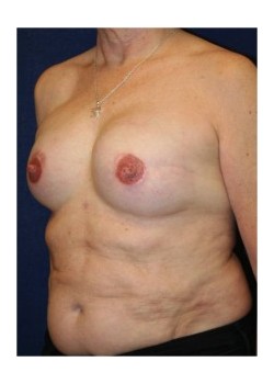 Implant (shaped) breast reconstruction