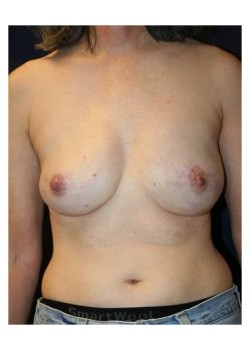 Implant (shaped) breast reconstruction