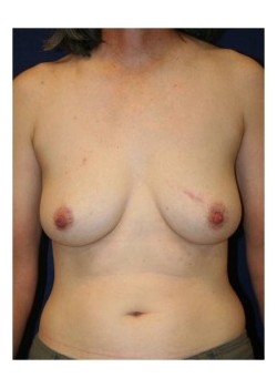 Implant (shaped) breast reconstruction