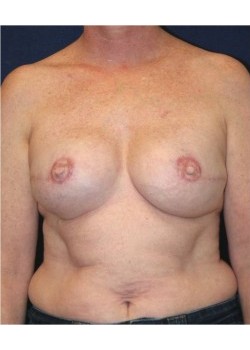 Implant (shaped) breast reconstruction