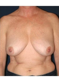 Implant (shaped) breast reconstruction