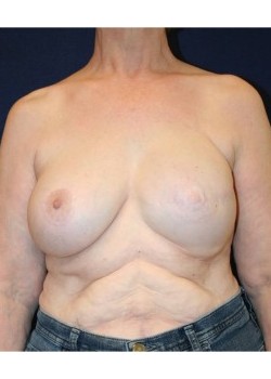 Unilateral implant breast reconstruction