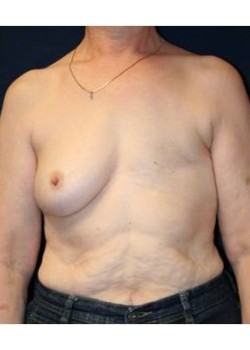 Unilateral implant breast reconstruction