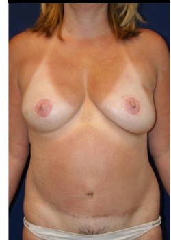 Bilateral DIEP flap breast reconstruction