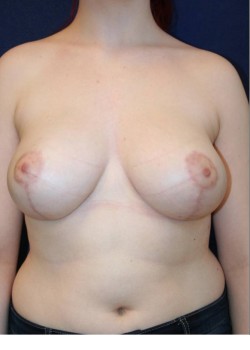 Breast Reduction – Short scar/vertical pattern