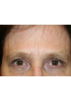 Browlift and upper blepharoplasty