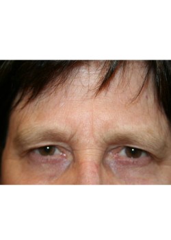 Browlift and upper blepharoplasty