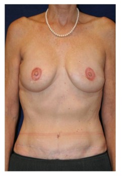 Bilateral DIEP Breast Reconstruction