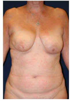 Bilateral DIEP Breast Reconstruction