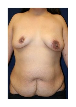 Abdominoplasty, breast augmentation and mastopexy