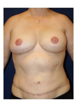 Bilateral DIEP flap