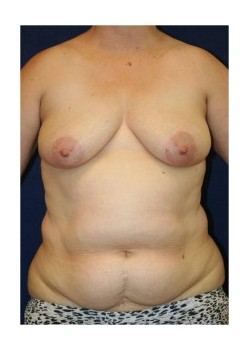 Bilateral DIEP flap