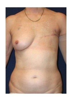Muscle-sparing TRAM flap