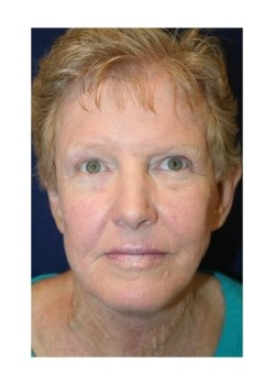 Facelift and upper blepharoplasty